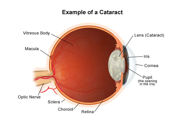 Cataracts