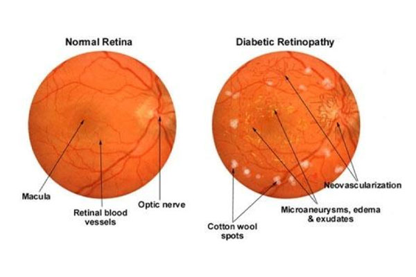 Diabetic Retinopathy